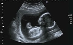 Ultrasound Echography of a 4th Month fetus, Italian Laboratories